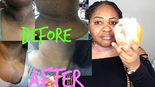 MY SKIN WHITENINGBLEACHING ROUTINE HOW TO LIGHTEN UNDERARMS amp NECK CAROWHITE REVIEW [upl. by Irrehs578]