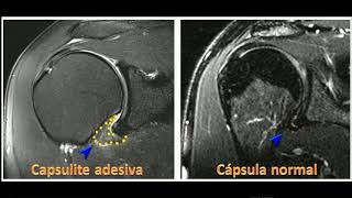 Capsulite adesiva [upl. by Amador153]