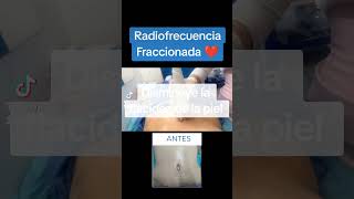 🔥Radiofrecuencia Fraccionada 🔥 medicaldigitusdeus radiofrecuenciafraccionada estrías [upl. by Richer931]