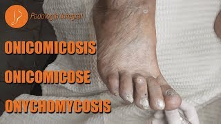 Fungus  Onychomycosis podology asmr [upl. by Barbie]