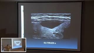 Echographie Thyroidienne Nouvelle Classification Dr JYacoubi [upl. by Cornell]