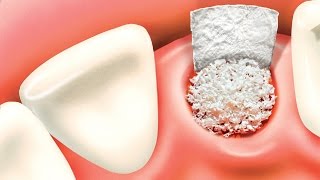 Bone grafting procedure [upl. by Earle]