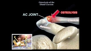 Distal Clavicle Osteolysis  Everything You Need To Know  Dr Nabil Ebraheim [upl. by Jean807]