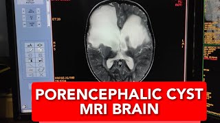 How to Read MRI Brain of 2 years Baby Diagnosing Large Porencephalic Cysts in English [upl. by Onibas548]