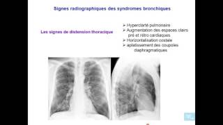 Les Grandes syndromes pulmonaires Partie 6 [upl. by Acinoev]