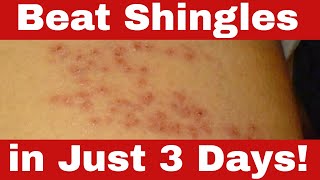 How to Cure Shingles in 3 Days  Simple Proven Home Remedies [upl. by Nosnarb]