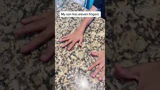 My son has 11 fingers unbelievable wrong funny [upl. by Jacquie]