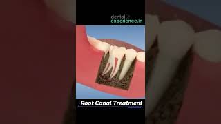 Root Canal Treatment Cost in Kochi Kerala [upl. by Clute]