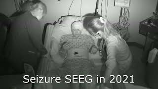 Seizure Clips of Epilepsy Progression [upl. by Leiad]