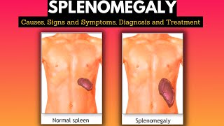 Splenomegaly Causes Signs and Symptoms Diagnosis and Treatment [upl. by Brodie190]