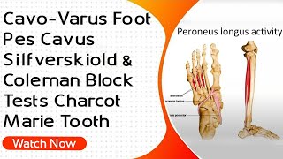 CavoVarus Foot  Pes Cavus  Silfverskiold amp Coleman Block Tests Charcot Marie Tooth [upl. by Adnocahs212]