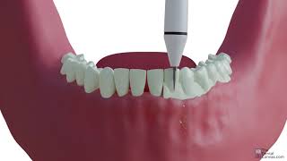 Scaling  Dental Procedures [upl. by Kedezihclem]