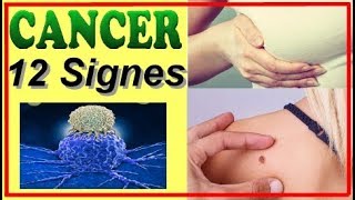 les signes potentiels de cancer a surveiller au quotidien [upl. by Leitao]