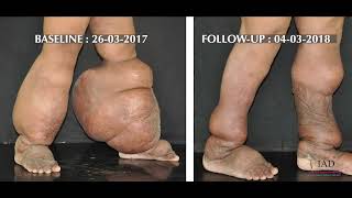 Lymphatic Filariasis  Lymphedema I हाथी पांव I Integrative Medicine  IAD [upl. by Guillema]