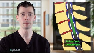 Cervical Myelopathy – Dr George Fryhofer [upl. by Dorfman]