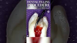 Dental Filling Procedure Cavity Filling dental dentist cavityfilling medical medicine shorts [upl. by Kcirrem507]