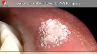 ORAL LESION REMOVAL Fotona Lightwalker ErYAG laser [upl. by Arun]