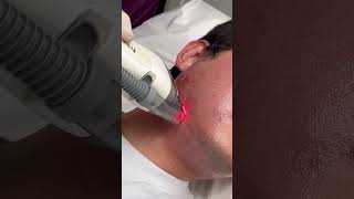 Dr Molinari  Traitement acné 2ème partie  laser Fraxel [upl. by Eidnahs]