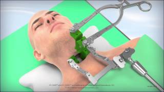 CS1600L Cervical Retractor Animation [upl. by Attenyt]