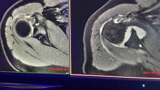 Complejo de buford lesión de labrum y ligamentos de hombro [upl. by Lu]