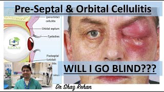 Cellulitis Learn All About PreSeptal amp Orbital Cellulitis I Dr Shaz Rehan 2023 [upl. by Heidt]