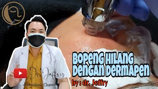 BOPENG TREATMENT dengan Dermapen di NATASHA SKIN CARE PADANG  dr JEFFRY [upl. by Maury]