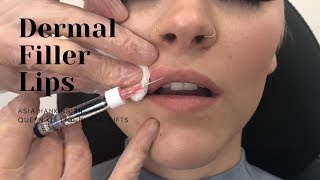 Dermal Filler Lips  1 Syringe RESTYLANE [upl. by Suhpoelc]