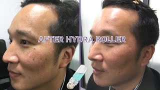 How to use hydra roller 64 needles at home Microneedling at home mesotherapy microneedling [upl. by Ennaej]