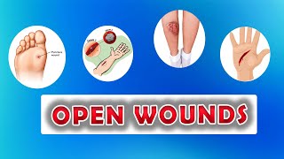 Types of Open Wounds Abrasion Laceration Skin Avulsion Puntured wounds [upl. by Nanaek]