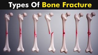 Common types of Bone fracture  3D animation [upl. by Slayton]