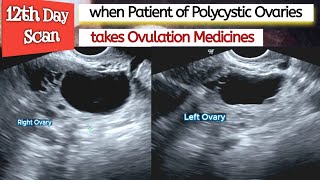 Ovarian CYSTS  Ovulation Medicines in PCOS Patient  Polycystic Ovaries  Infertility [upl. by Idonah]