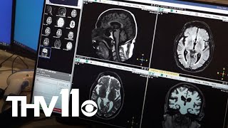 How AI is improving neuroradiology services in Arkansas [upl. by Sorcim485]