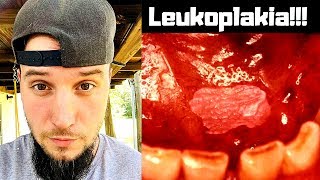 Dangers of Dipping 1 Leukoplakia [upl. by Carrick]