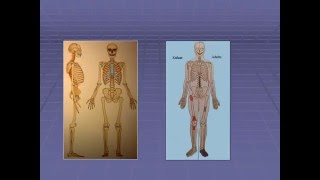 traumatologie L’OSTEOMYELITE AIGUE HEMATOGENE [upl. by Etteloiv]