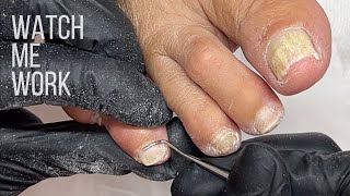 Gentle salon pedicure for mature feet Involuted nails cut too short Watch Me Work [upl. by Yahs509]