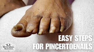 Fix your Ingrown Pincer Nails at Home [upl. by Klemperer712]