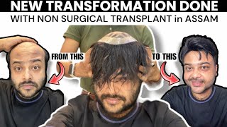 Finally Transformed Myself in 13 minutes with Non Surgical Hair Transplant in Guwahati 🔥 [upl. by Hyozo]