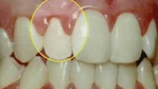 Periodontal Disease amp Treatment [upl. by Nivonod]