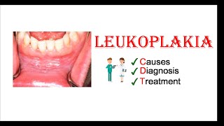 Leukoplakia  Causes Diagnosis amp Treatment [upl. by Oigroeg]