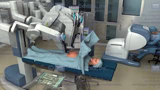 Medical Animations of Robotic Surgery [upl. by Ivad]