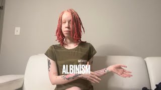 What is Albinism My experience tips amp advice [upl. by Vacla]