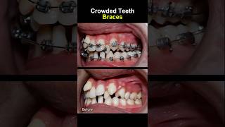 Teeth very crowded and crooked before braces orthodontist braces dentist [upl. by Oicnoel883]