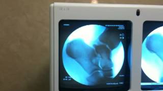 Intraoperative Fluoroscopy of Anterior Drawer in Ankle Instability SFSIM [upl. by Euqinehs]