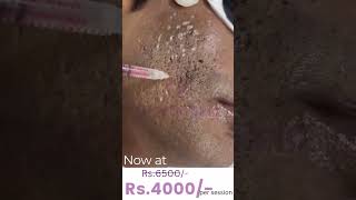 Acne scar Treatment TCA CROSS flawlessskin KrystalskinclinicHyderabad [upl. by Gonnella233]