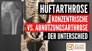 Konzentrische Hüftgelenkarthrose  Die Besonderheiten dieser Arthroseform [upl. by Low218]