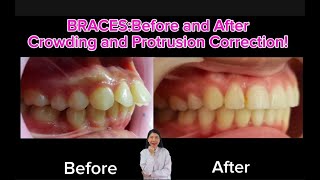 BracesBefore and After Crownding and Protrusion Correction [upl. by Belen]