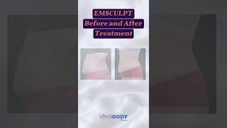 EMSCULPT BEFORE AND AFTER emsculpt emsculptneo emsculpttreatment [upl. by Ragas]