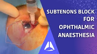 Subtenons block regional anaesthesia for ophthalmic surgery Live patient UPDATE [upl. by Sivi]