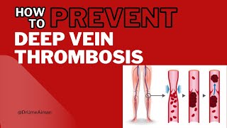 Deep Vein Thrombosis  How to prevent DVT [upl. by Ytirehc]