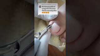 Hidden Toenail Thorns nail​​​ asmr fyp ear shorts viral wax [upl. by Vidal]